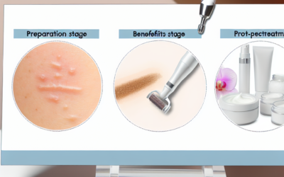 Alt du skal vide om microneedling: Forberedelse, Fordele og Efterbehandling