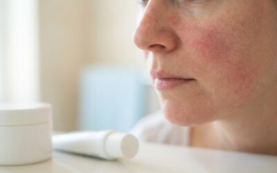 Rosacea: Skånsom pleje, triggere og hvad du skal undgå