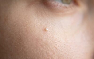 Talgknopper og milier: Hvorfor de kommer – og hvad du kan gøre uden at skade huden