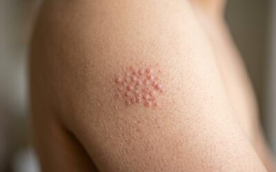 Keratosis pilaris (nupper på overarme og lår): Årsager, pleje og behandling der virker